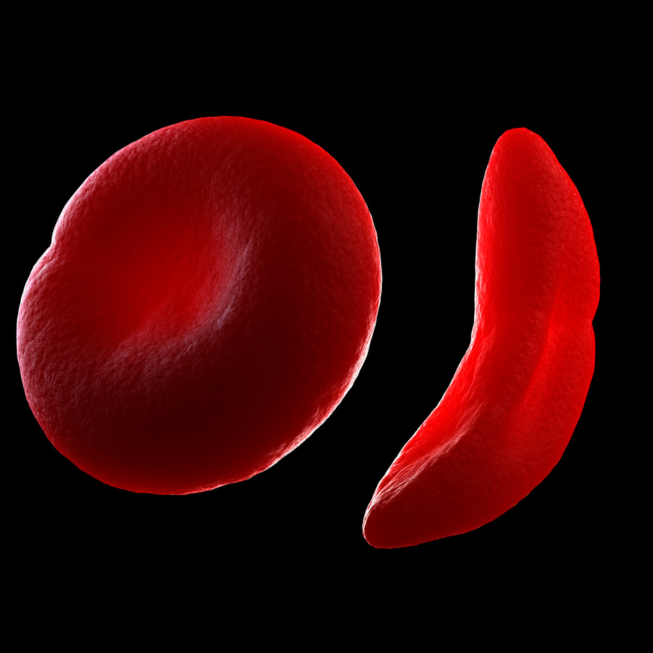 "Sickle cell anaemia